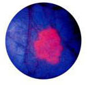 Диагностика рака мочевого пузыря за рубежом. DiaPat-BC-Test.